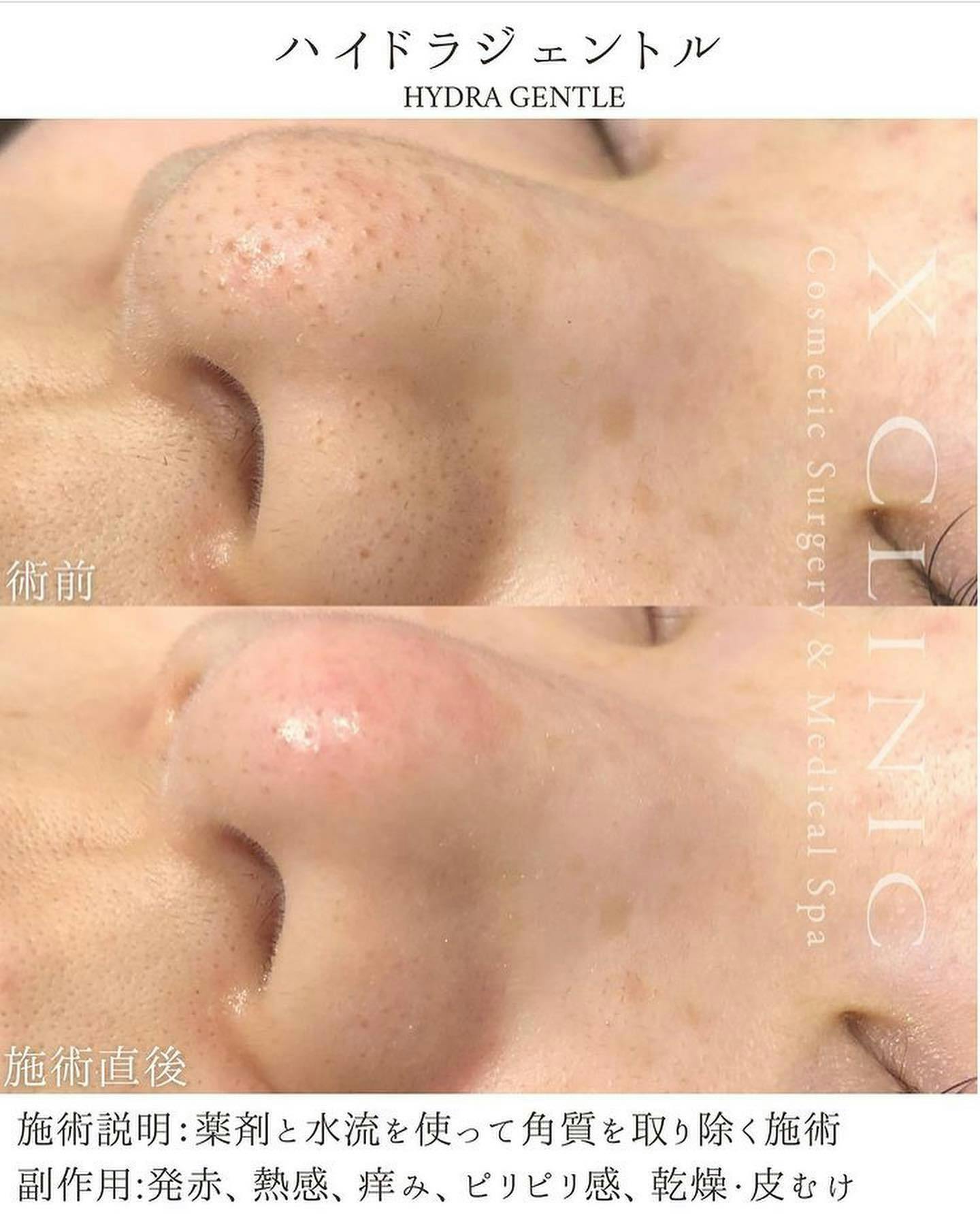 【女性・毛穴】ハイドラジェントル _before_aftar