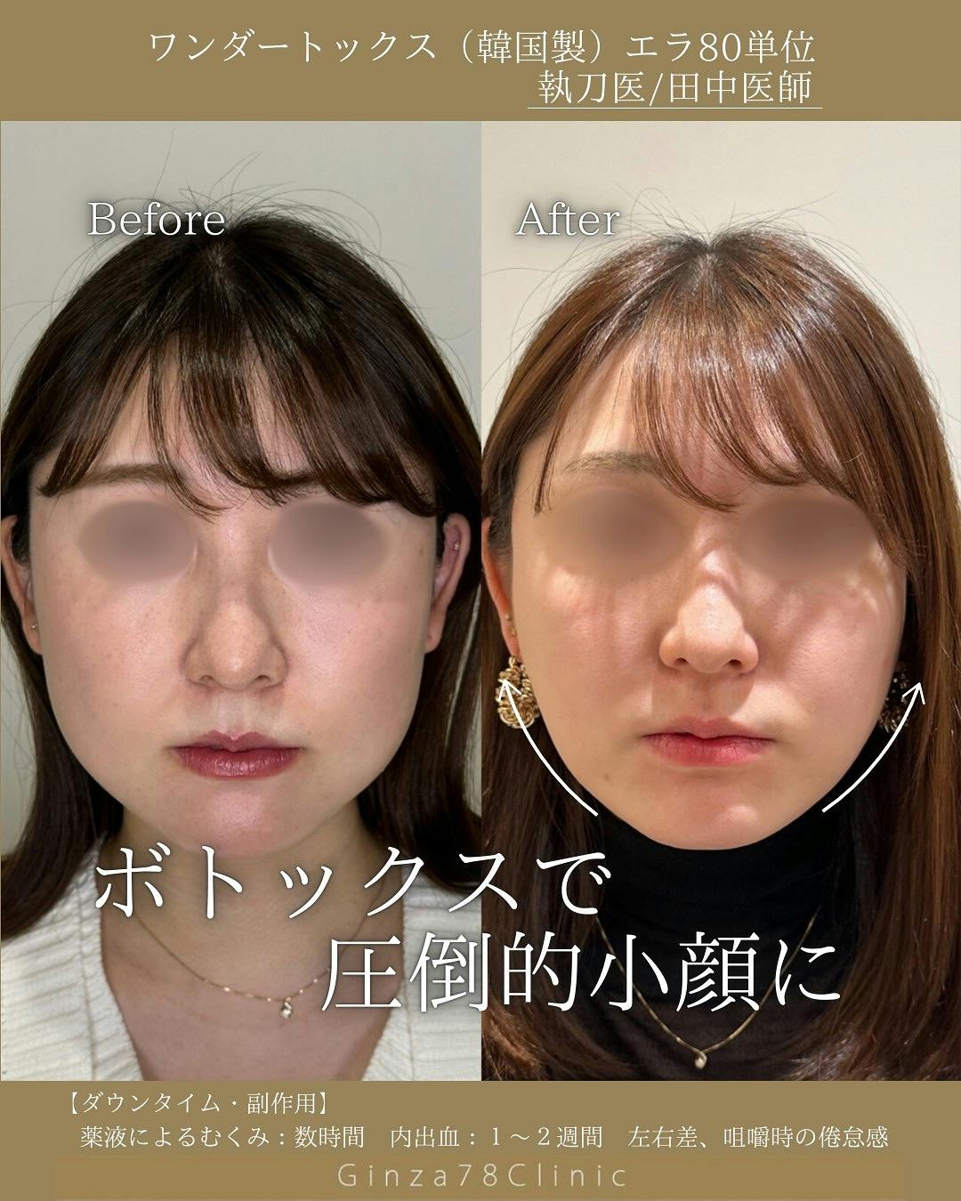 【女性・小顔】ボトックス(韓国製)_before_aftar