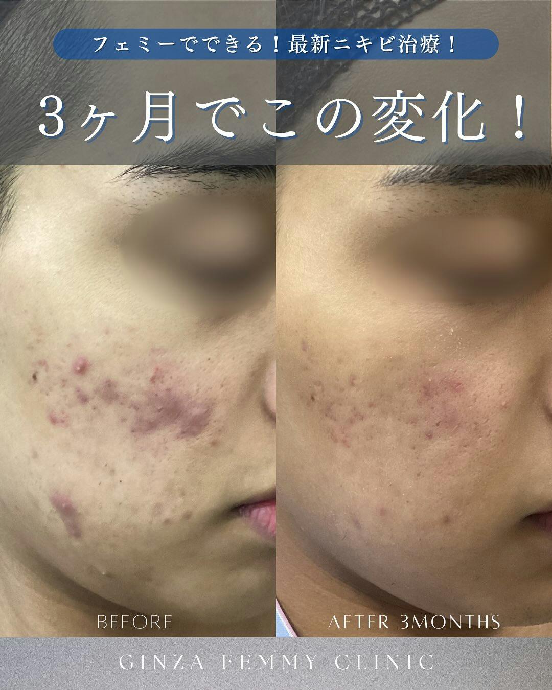 【男性・ニキビ】ニキビ治療_before_aftar