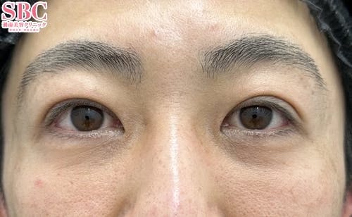 【40代男性・目元】目の下の切らないクマ・たるみ（ふくらみ）取り・ナチュラル脂肪注射コンデンスリッチ・ヒアルロン酸_after