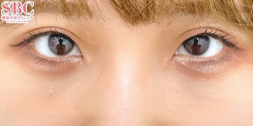 【女性・クマ】目の下の切らないクマ・たるみ（ふくらみ）取り、ナチュラル脂肪注射ナノリッチ、ナチュラル脂肪注射コンデンスリッチ_after