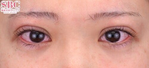 【20代女性・目元】クイックコスメティーク・トリプルNeo_0day