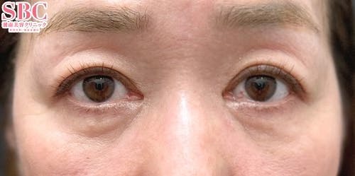 【50代女性・クマ】目の下の切らないクマ・たるみ（ふくらみ）取り、ナチュラル脂肪注射コンデンスリッチ、ナチュラル脂肪注射ナノリッチ_after