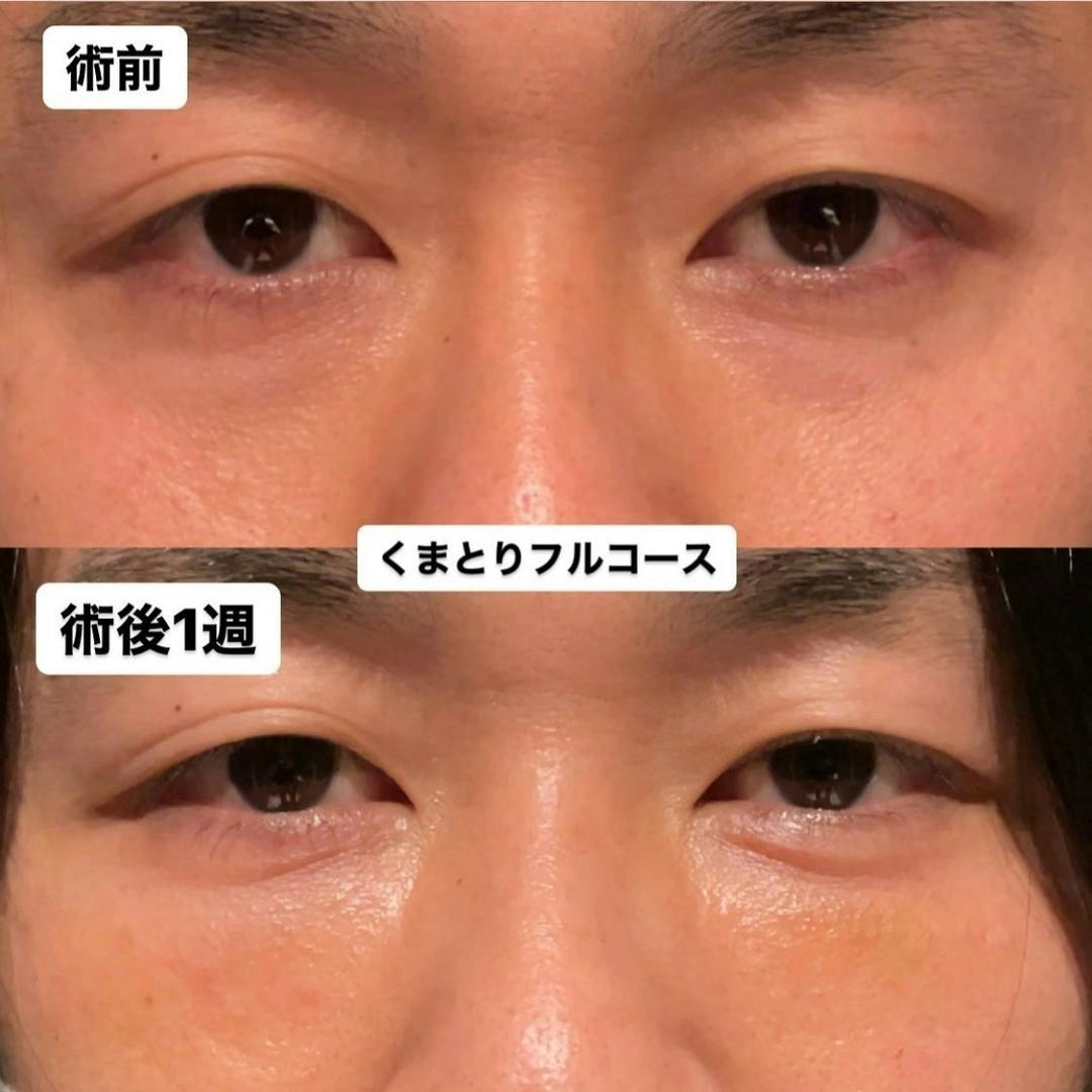 【目元】くまとりフルコース_before_aftar