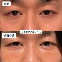 【目元】くまとりフルコース_before_aftar