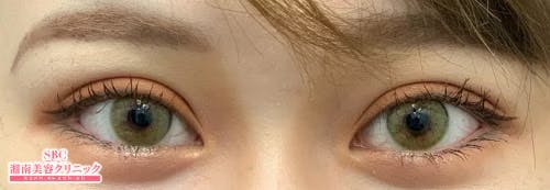 【女性・目元】線留めクロス二重術_aftar