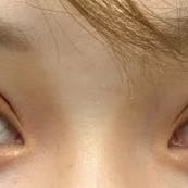 【女性・目元】線留めクロス二重術_aftar