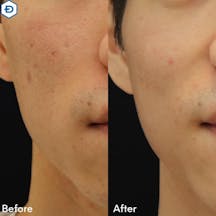 【男性・毛穴】PRPダーマペン_before_aftar