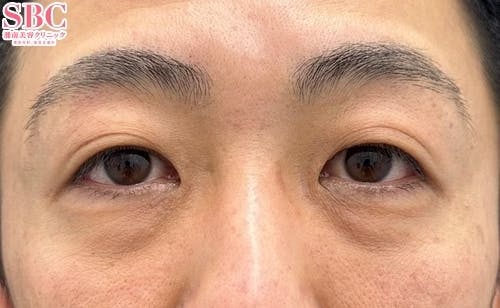 【40代男性・目元】目の下の切らないクマ・たるみ（ふくらみ）取り・ナチュラル脂肪注射コンデンスリッチ・ヒアルロン酸_before