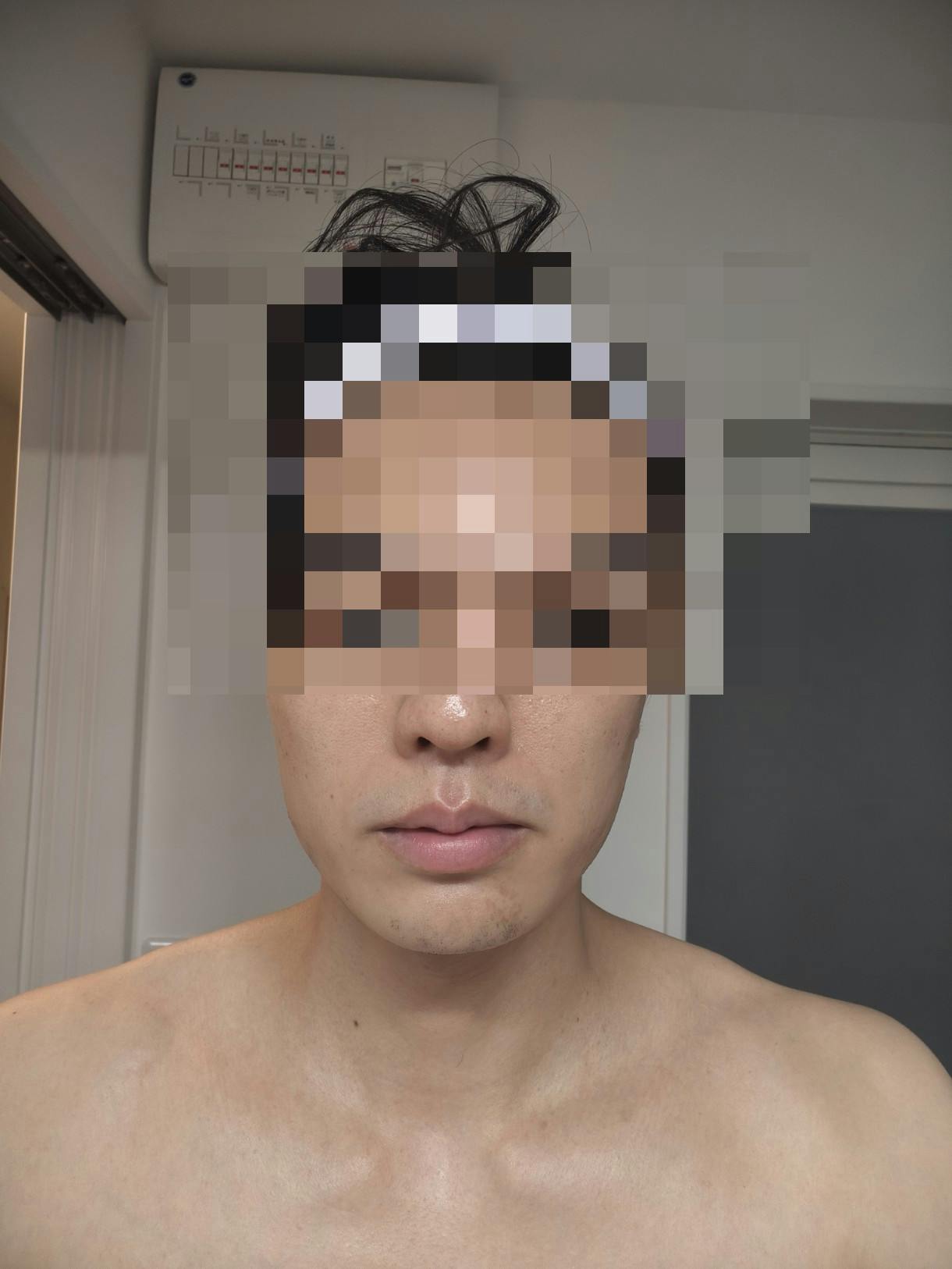 SBC NEO Skin Clinic 恵比寿でヒゲ脱毛を受けたk..yamaguchiさんの写真