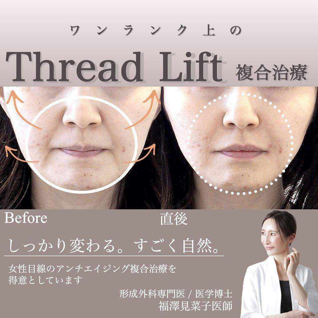 【女性・法令線】糸リフト、ヒアルロン酸_before_aftar