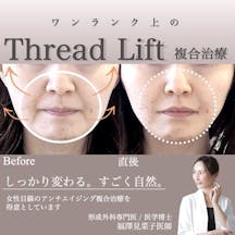 【女性・法令線】糸リフト、ヒアルロン酸_before_aftar