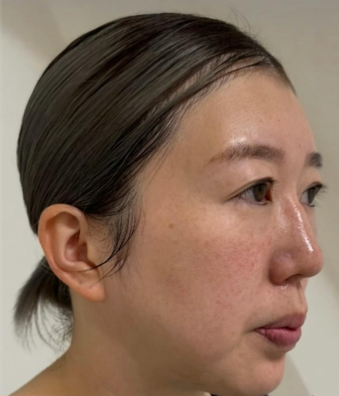 【女性・フェイスライン】アルテミスリフト_b1