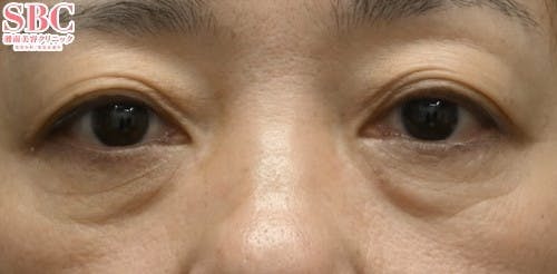 【女性・目元】切開ハムラ(表ハムラ)法 リジュランi_before