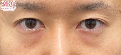 【30代男性・クマ】目の下の切らないクマ・たるみ（ふくらみ）取り ナチュラル脂肪注射コンデンスリッチ ナチュラル脂肪注射ナノリッチ_before