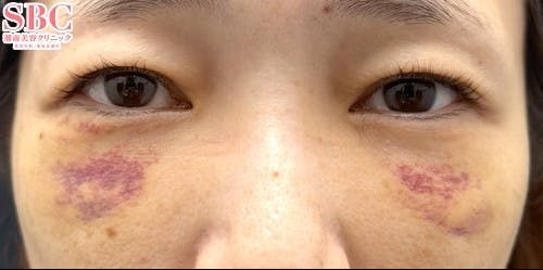 【30代女性・クマ】裏ハムラ法 SBCプレミアムPRP皮膚再生療法_1week
