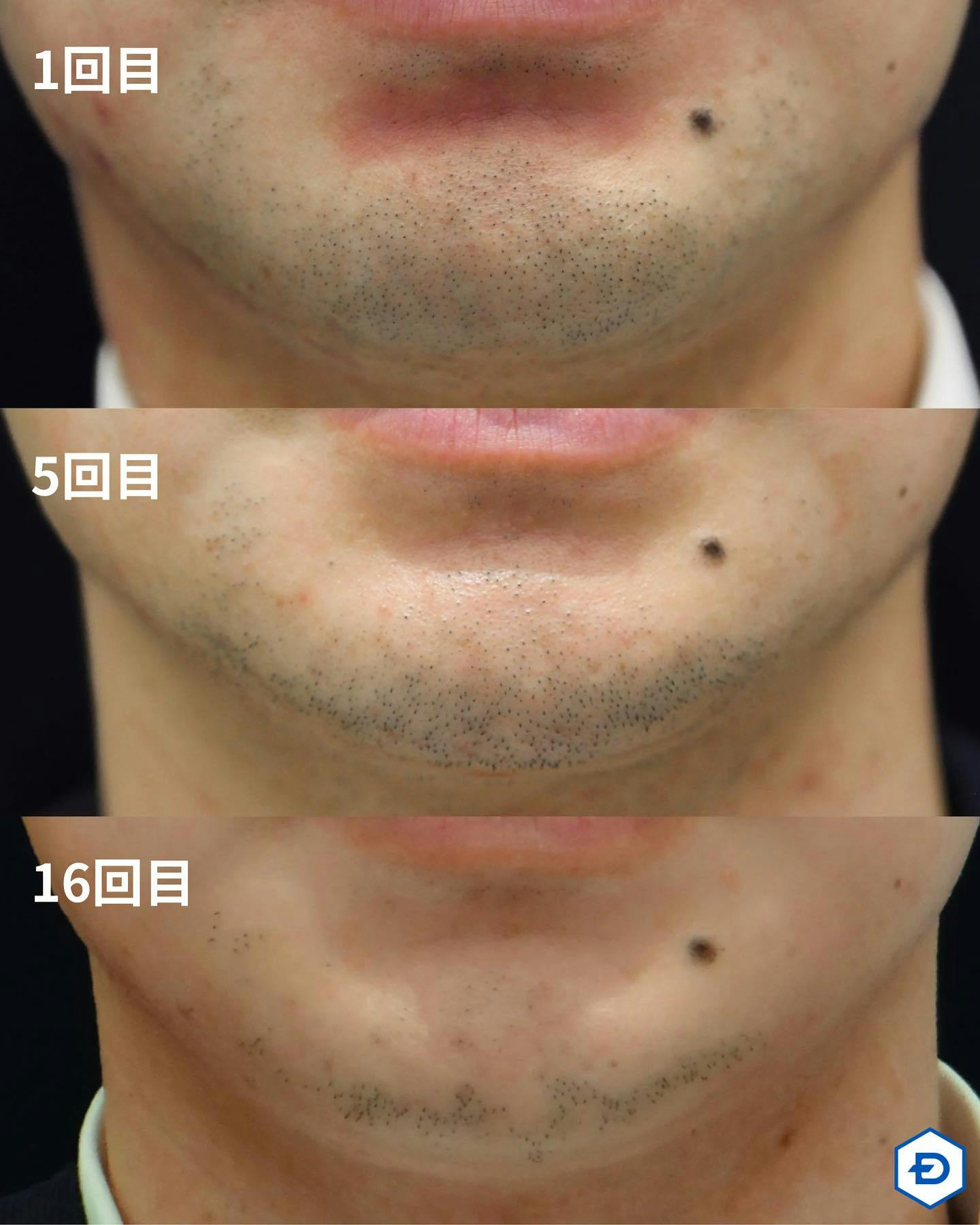 【男性・ヒゲ】ヒゲ脱毛_before_aftar