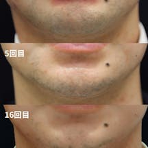 【男性・ヒゲ】ヒゲ脱毛_before_aftar