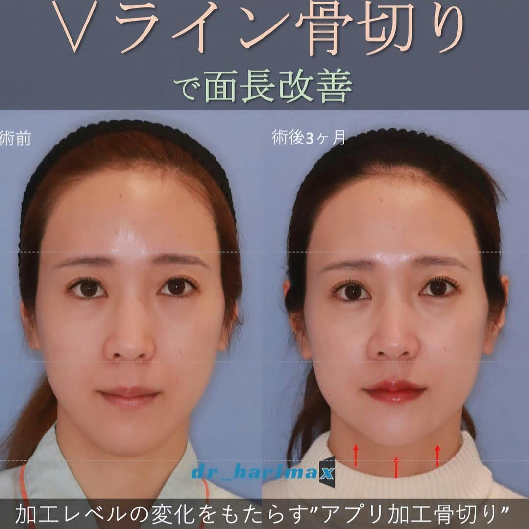 【女性・顎】Vライン骨切り_before_aftar