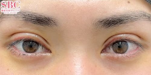 【目元】眼瞼下垂 タルミ取り併用全切開法二重_aftar