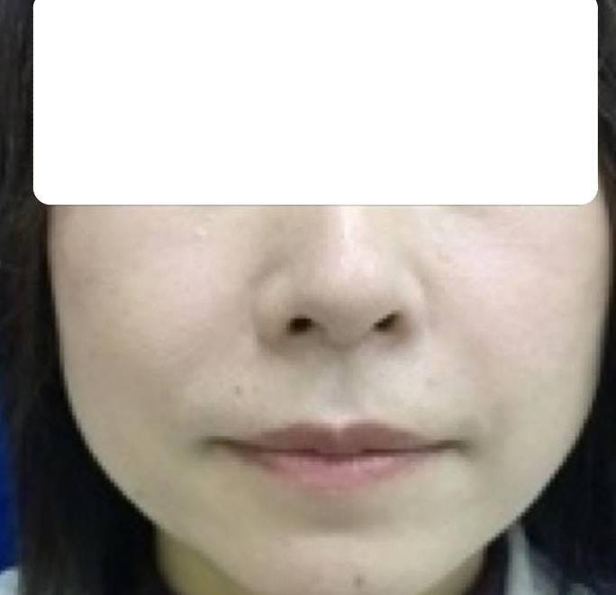 湘南美容クリニック 仙台院でhttps://crowdworks.jp/attachments/55692280.jpgを受けたなおさんの写真