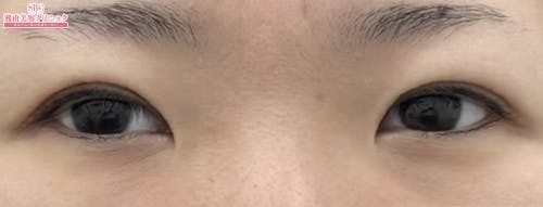 【30代女性・目元】週末二重(R)_before
