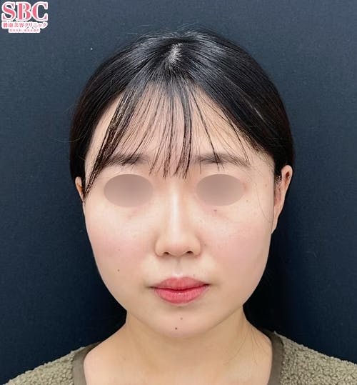 【20代女性・顔・頬】小顔用脂肪吸引注射・メーラーファット除去術_1week