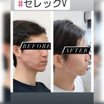 【男性・肌】IPL光治療セレックV_before_aftar