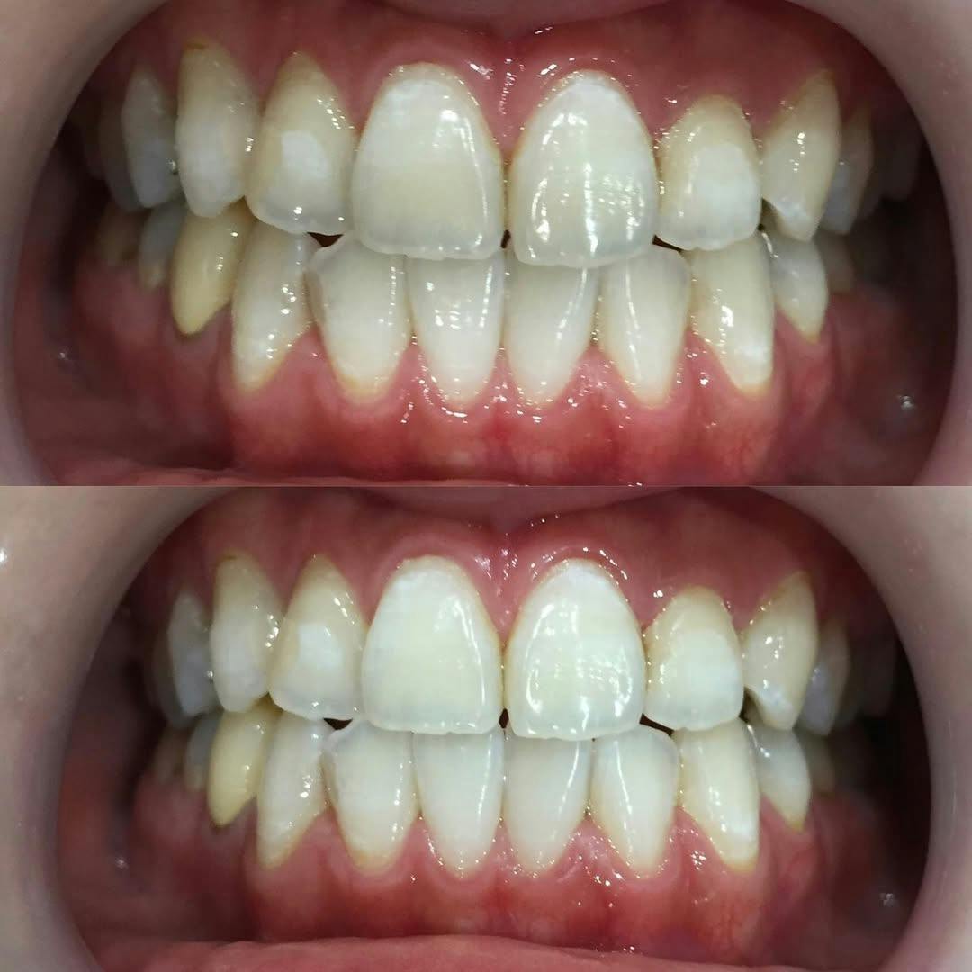 【歯】オフィスホワイトニング_before_aftar