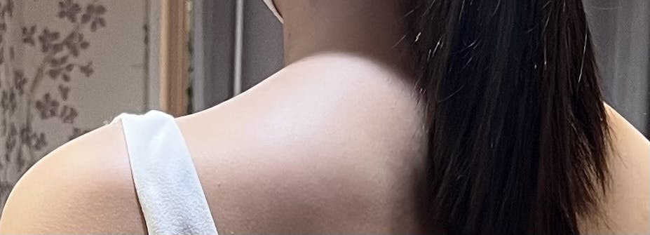 品川美容外科渋谷院(※品川スキンクリニック提携)で肩ボトックス注射・ボトックス注射・韓国製ボトックス・ボツリヌストキシン・アラガン製ボトックスを受けたりりさんの写真