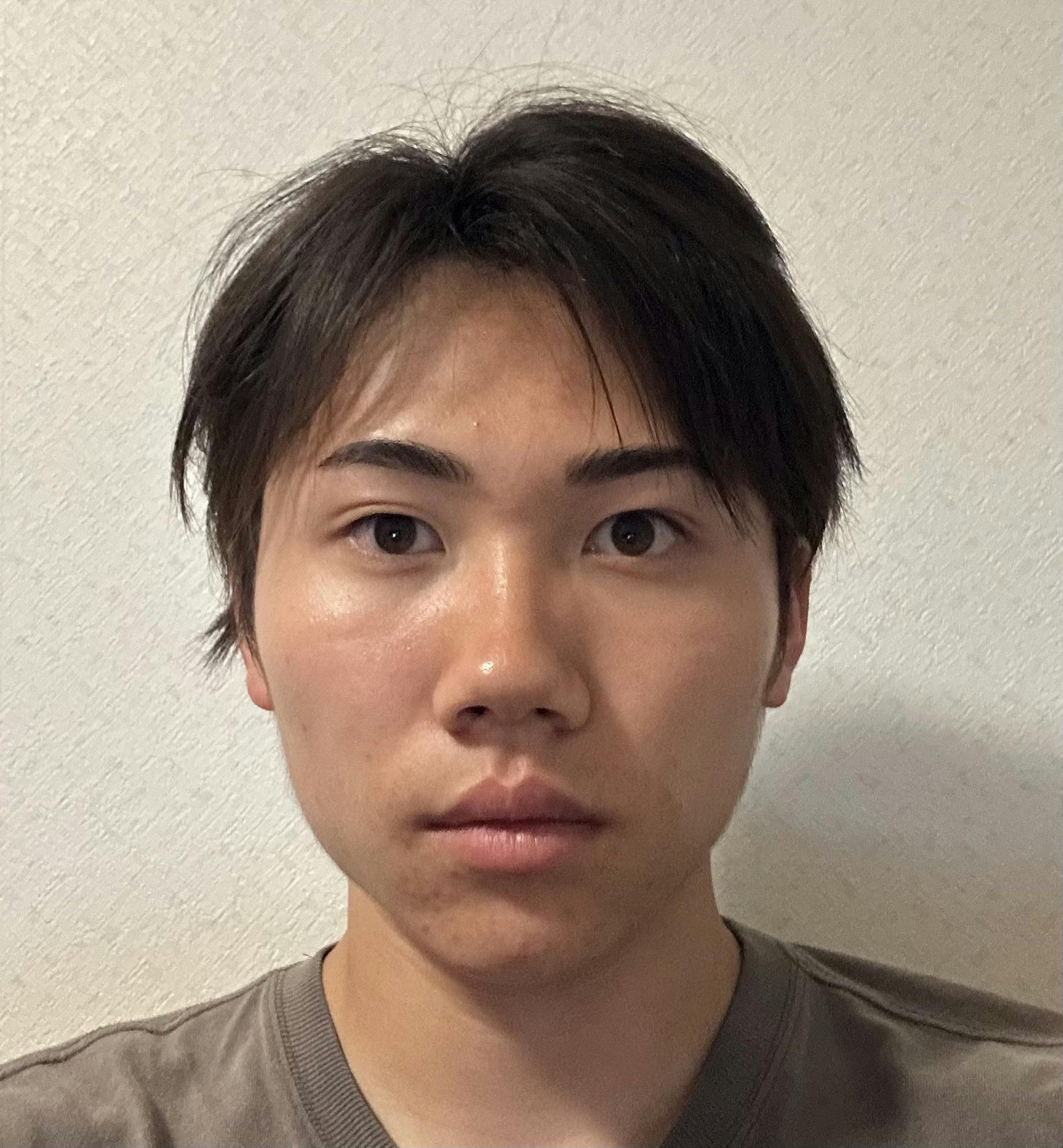 TCB東京中央美容外科 静岡院でボトックス注射・エラボトックス注射(小顔)・韓国製ボトックス・ボツリヌストキシンを受けたmさんの写真