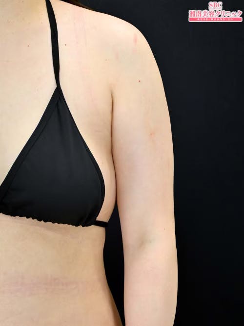 【20代女性・二の腕】クールスカルプティング(R)・ エリート（クルスカダブル） サクセンダ_after