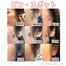 【女性・シミ】ピコスポット_before_aftar