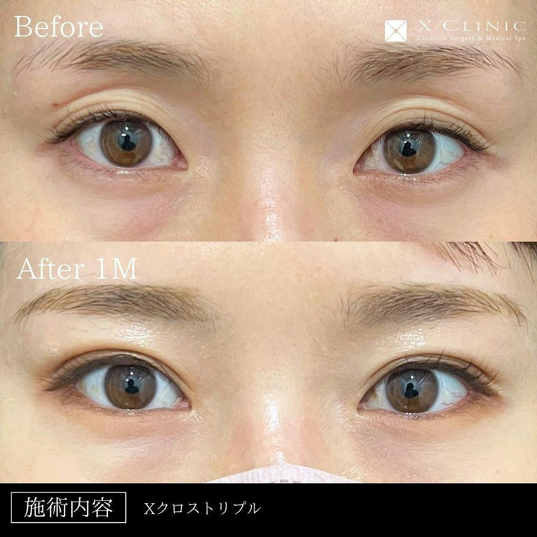 【30代女性・目元】Xクロストリプル_before_aftar