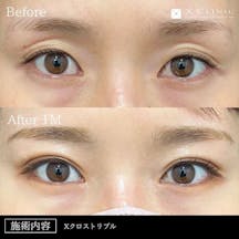 【30代女性・目元】Xクロストリプル_before_aftar