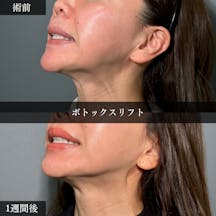 【40代女性・顔~首】ボトックスリフト(広頚筋ボトックス)_before_aftar