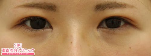 【女性・目元】クイックコスメティーク・ダブルNeo、目頭切開プレミアム、自然癒着セット（上眼瞼脱脂）_aftar