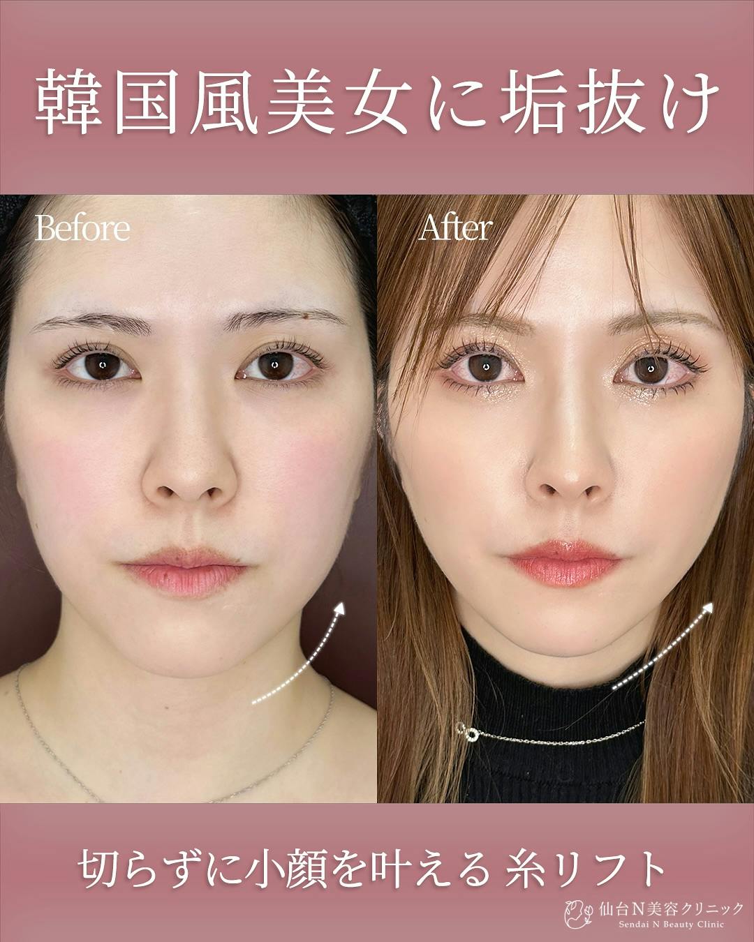 【女性・輪郭】糸リフト_before_aftar