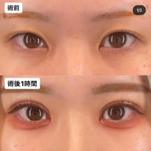 【女性・目元】Xクロスダブル(埋没二重)_before_aftar