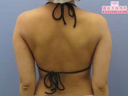 【女性・肩】ライポマティック脂肪吸引・根こそぎVASER脂肪吸引_before