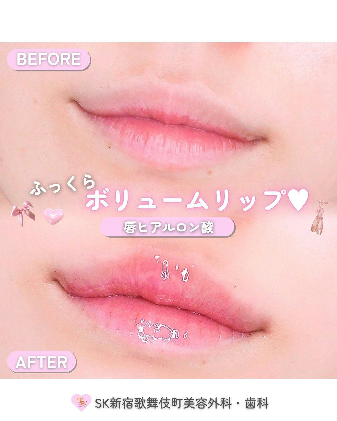 【女性・唇】唇ヒアルロン酸_before_aftar