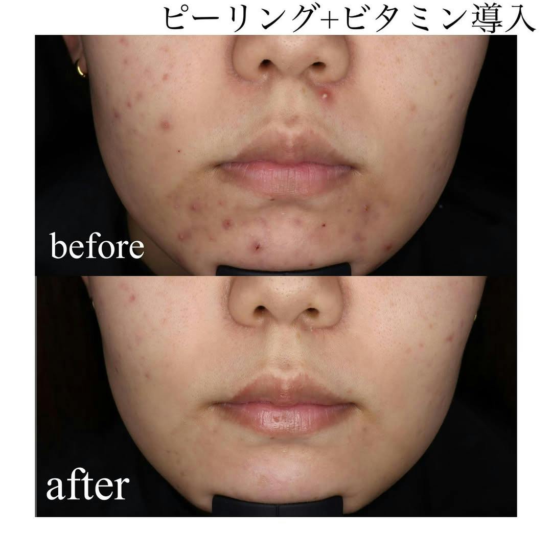 【女性・顔】ピーリング＋ビタミン導入_before_aftar