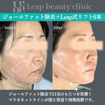 【40代女性・輪郭】ジョールファット除去・糸リフト_before_aftar