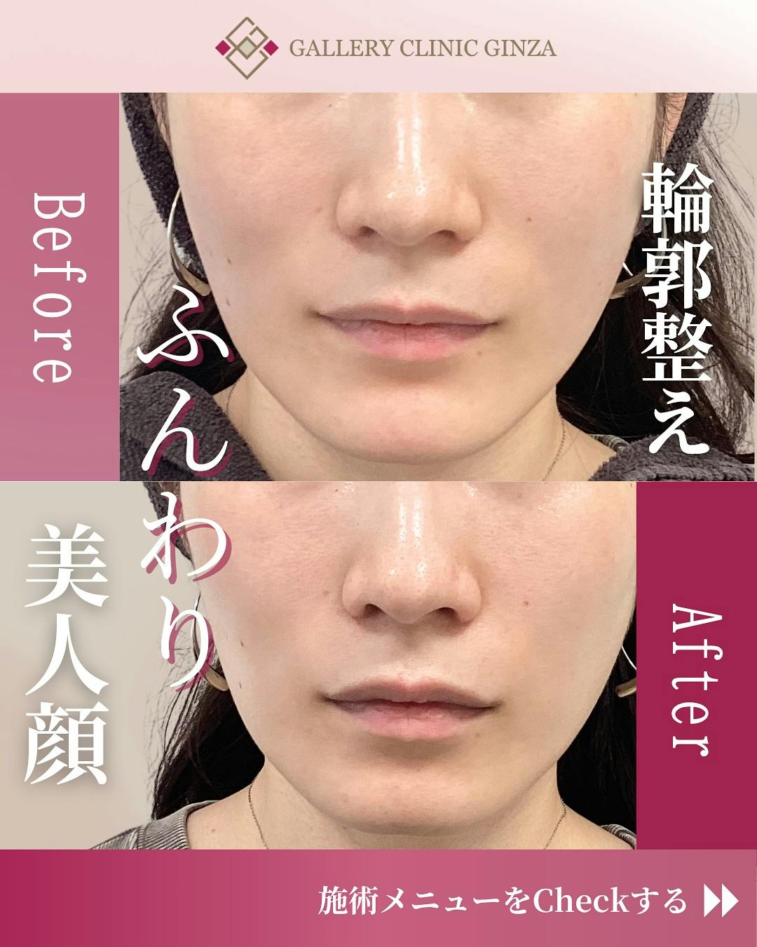 【女性・輪郭】ヒアルロン酸(顎あご・頬コケ)_before_aftar