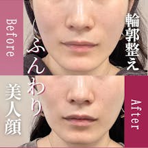 【女性・輪郭】ヒアルロン酸(顎あご・頬コケ)_before_aftar