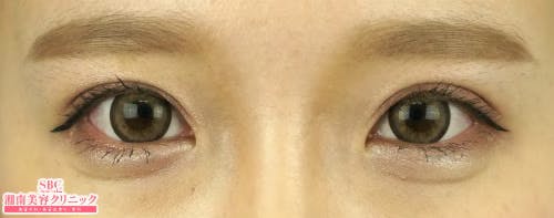【20代女性・目元】クイックコスメティーク・ダブルNeo_after