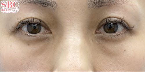 【女性・目元】目の下の切らないクマ・たるみ（ふくらみ）取り、ナチュラル脂肪注射コンデンスリッチ、ナチュラル脂肪注射ナノリッチ_before