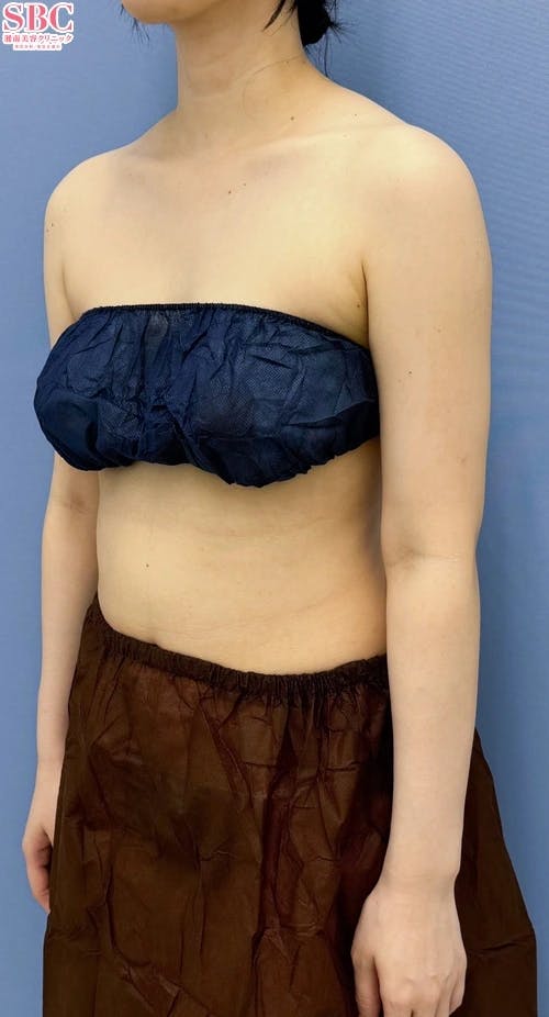 【30代女性・二の腕】根こそぎVASER脂肪吸引、Aquicell（アキーセル）脂肪吸引_aftar