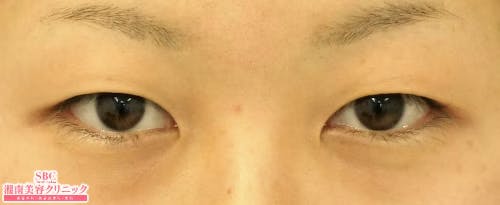 【20代女性・目元】クイックコスメティーク・ダブルNeo_before