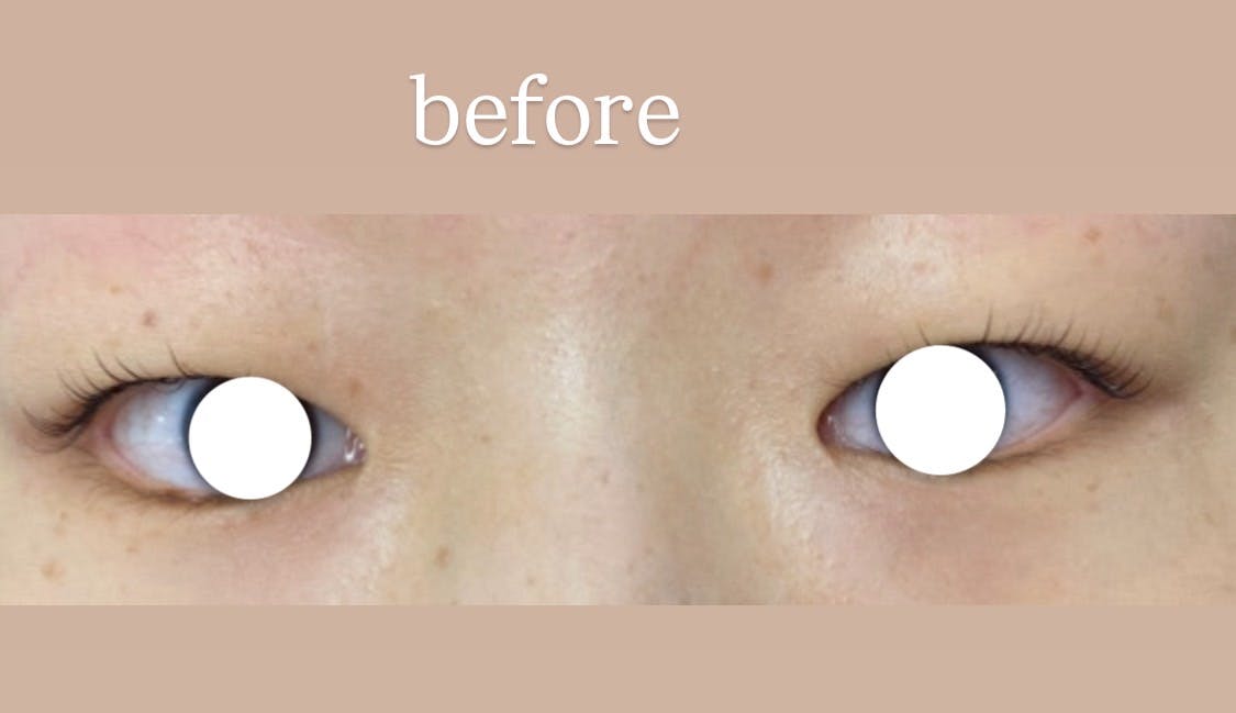 大塚美容形成外科 京都院で二重整形を受けたれさんの写真